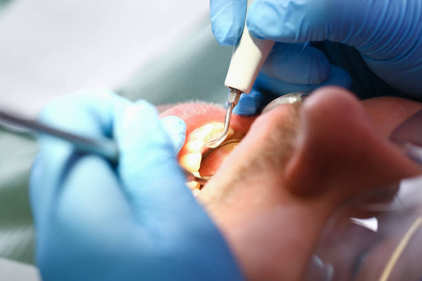 Best Emergency Dentist for Lost Fillings or Crowns in Whidbey Island Station, WA
